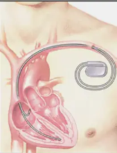 細數(shù)心臟起搏器和ICD之間的差異